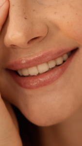 SONRISA GINGIVAL