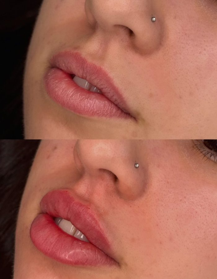 Aumento de Labios