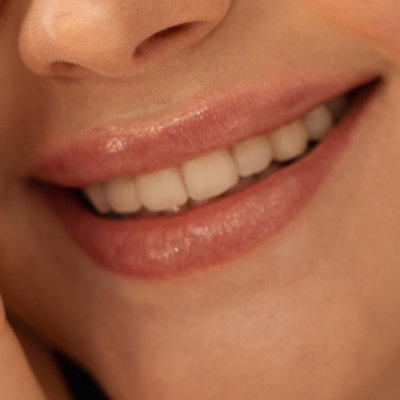 SONRISA GINGIVAL SONRISA GINGIVAL