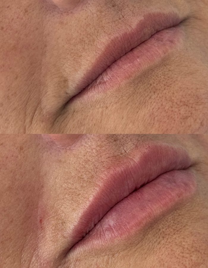 Aumento de Labios